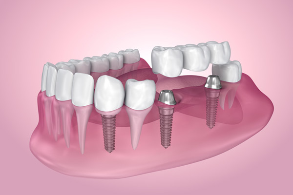 IMG-multiple-teeth-dental-implants-GettyImages-930377764