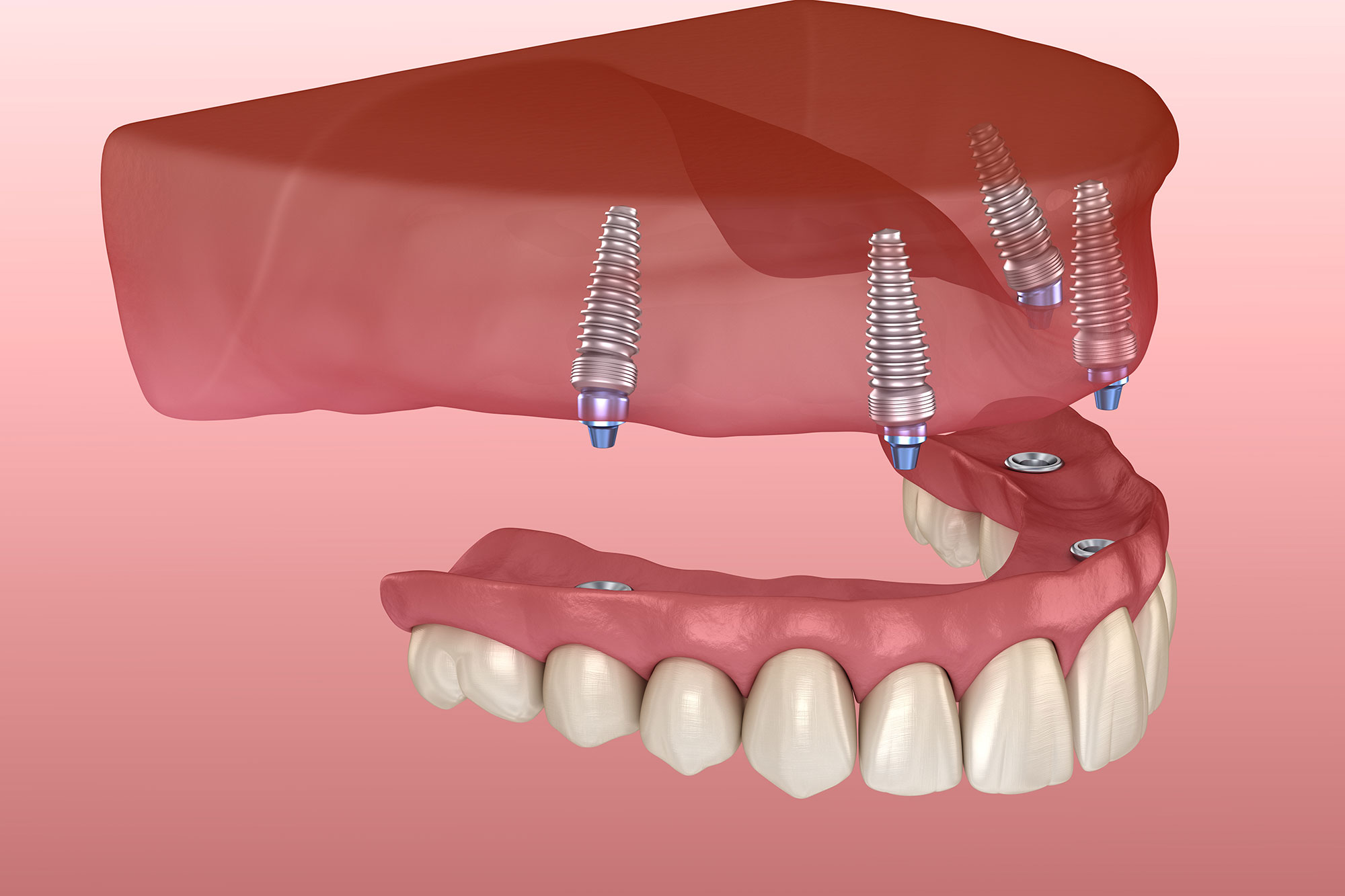 Implant-Supported-Dentures