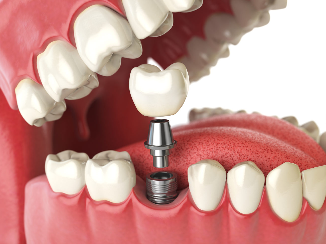 Tooth implant. Dental concept. Human teeth or dentures